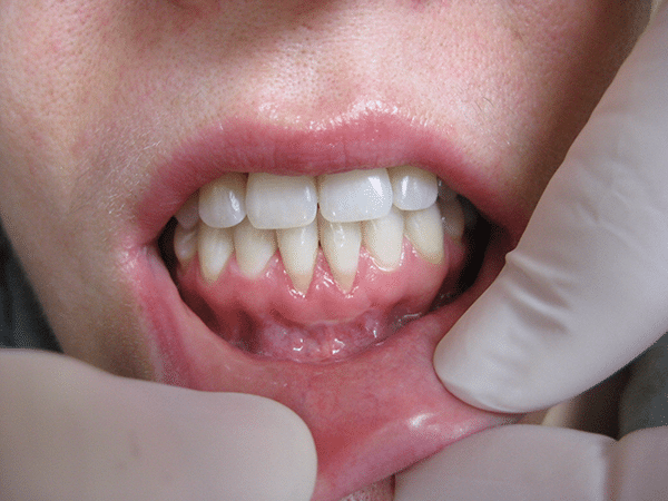 Understanding Gum Grafting