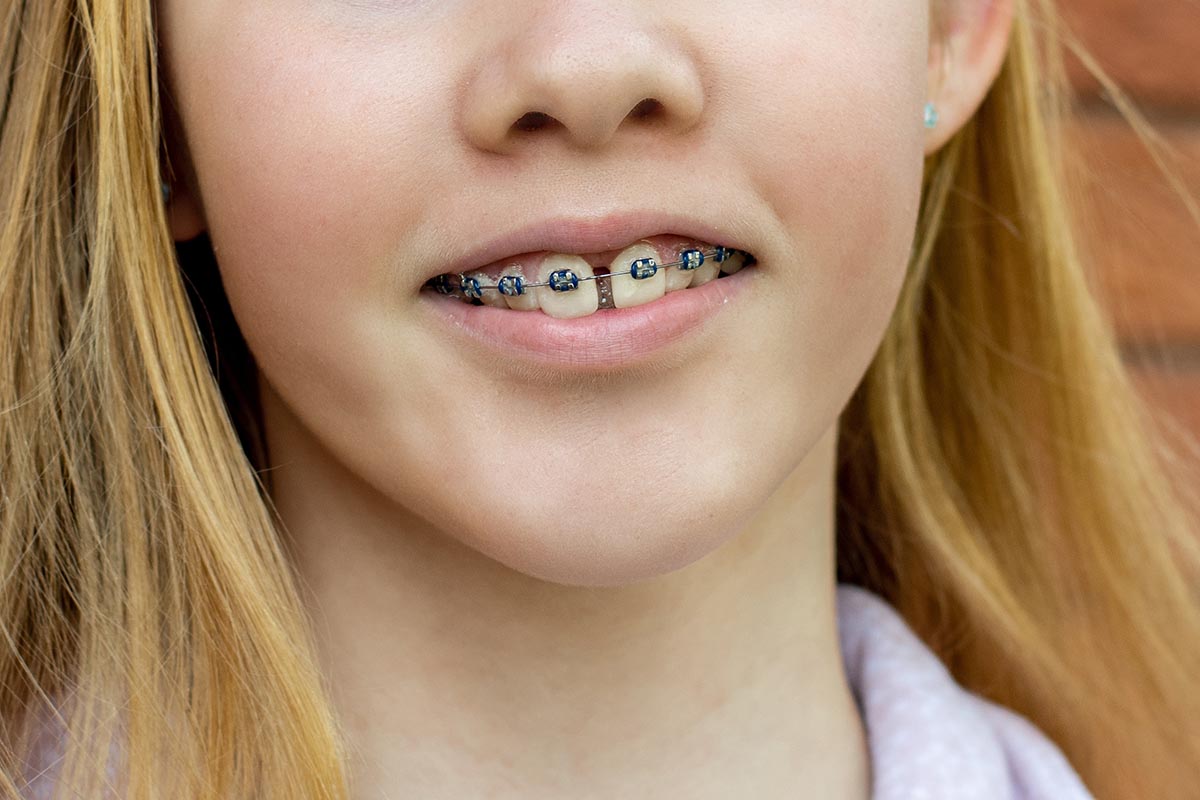 braces before and after gap